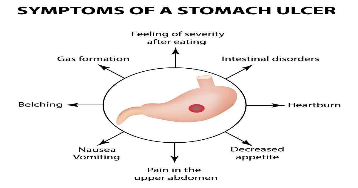 symtoms of stomach ulcer